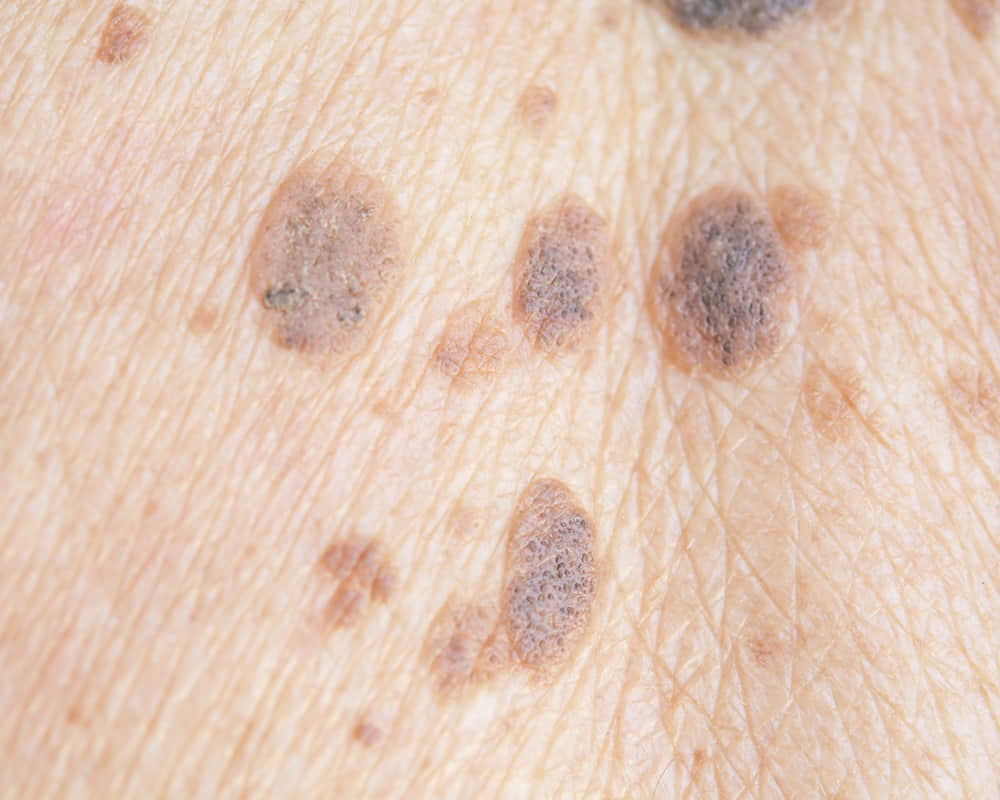 freckles-skin1000 皮膚的真相，看懂了，你就瞭解為何皮膚要窮養