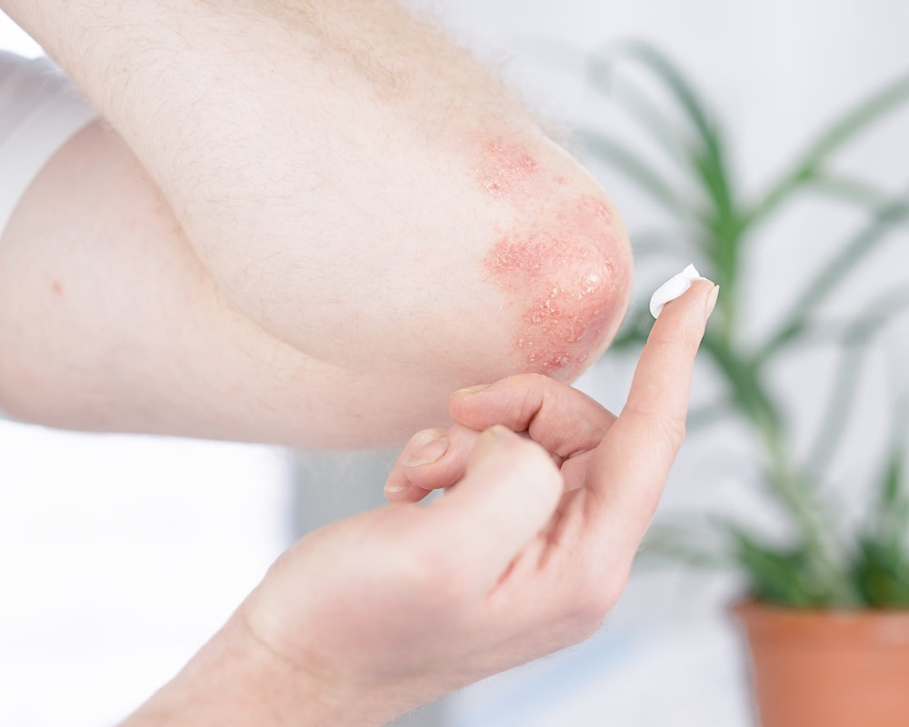 man-applies-cream-elbow-affected-by-psoriasis1000800 季節性過敏及過敏性皮膚炎的緩解與用藥問題？