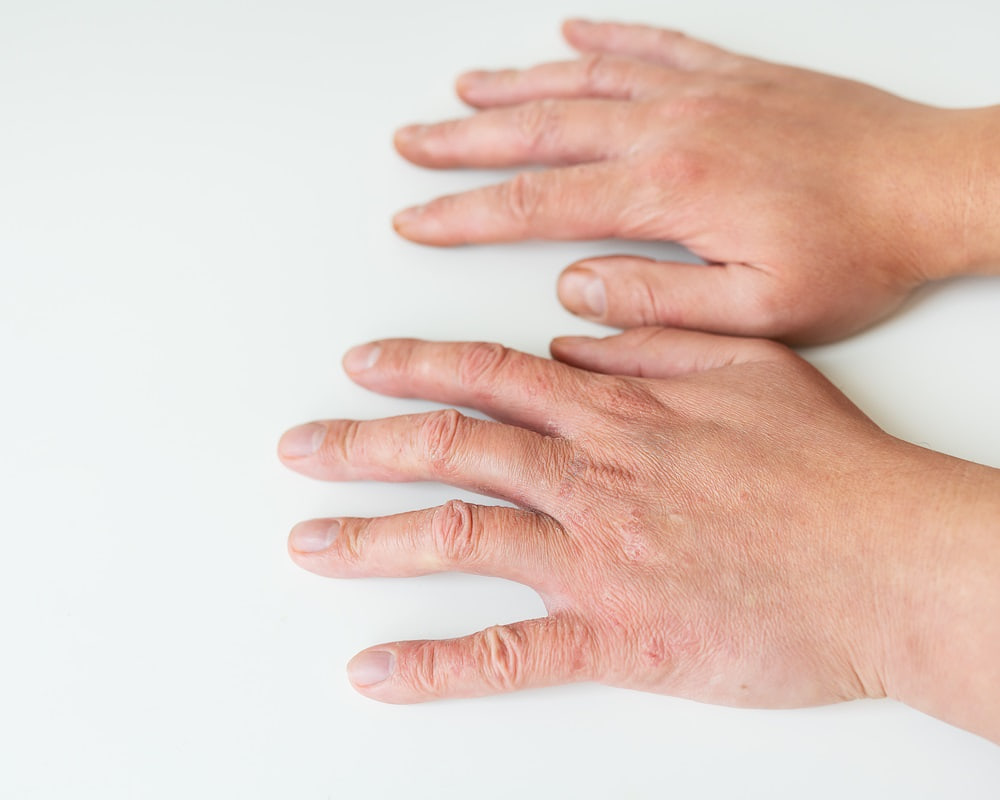 treating-skin-diseases-psoriasis-eczema-dermatitis-diathesis-human-hands-concept-medicine-treatment-direction-dermatology1000 精油的致敏與抗敏？過敏體質的人又該怎麼用呢？