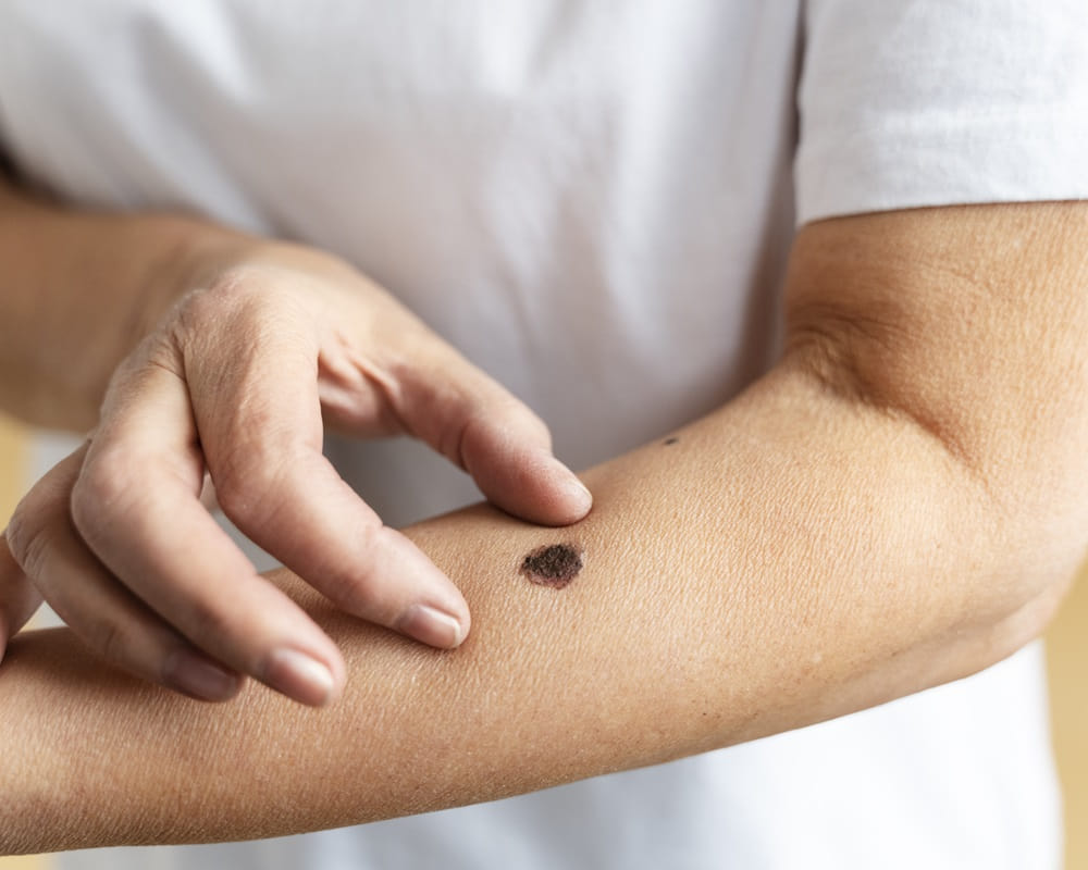 high-angle-hand-measuring-mole_skin_1000800 皮膚的真相，看懂了，你就瞭解為何皮膚要窮養