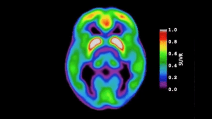 MRI-brain-scan 安眠藥長期吃會加速失智嗎？從大腦代謝廢物清除機制，看失智長者用藥安全與替代策略