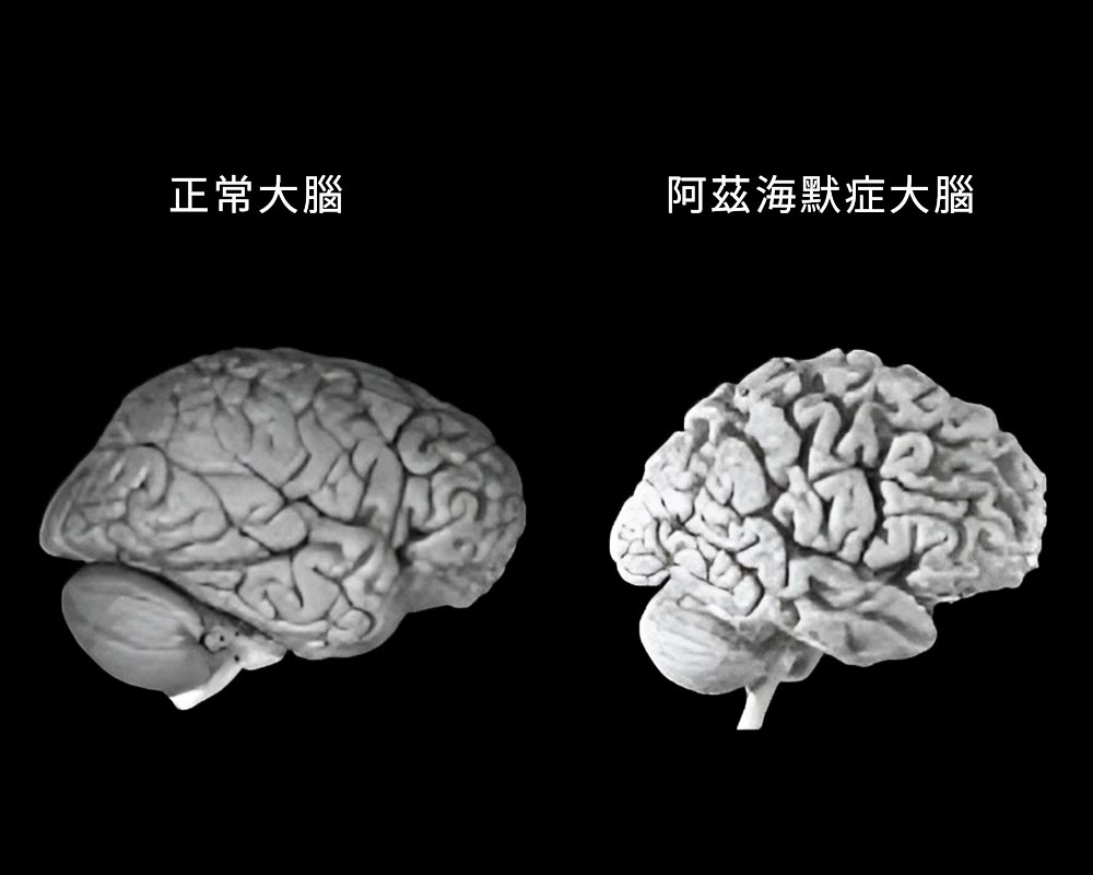 正常大腦-VS-阿茲海默症大腦 大腦悄悄變小了?認識腦萎縮的原因、影響與對策