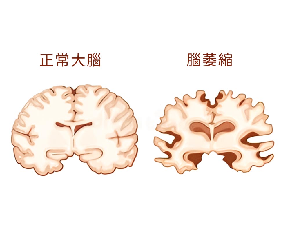 正常腦VS腦萎縮 大腦悄悄變小了?認識腦萎縮的原因、影響與對策