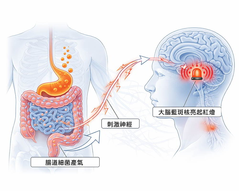 脹氣大腦亮紅燈 小腸細菌過度生長(SIBO)的中西醫整合視角:從「脾虛濕濁」到腸-腦軸失衡的系統性解構
